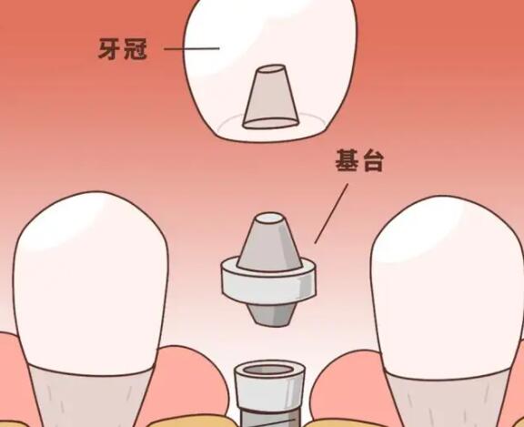 西安三甲医院：口腔科种植牙技术优势解析，预算可承受范围内