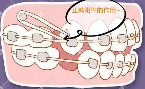 无锡隐形牙套医院推荐：2024时代天使矫正价格及排名参考