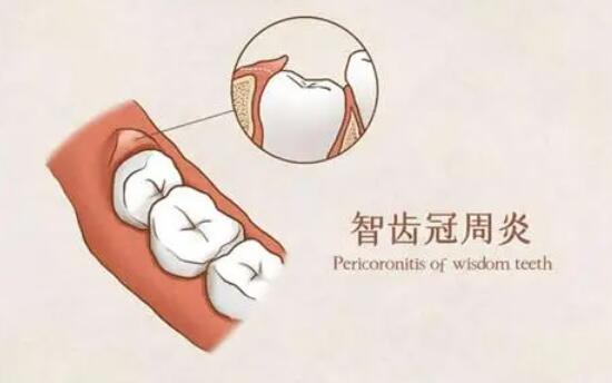 上海亿大口腔医院种植一颗牙价格解析，种植效果关键是什么