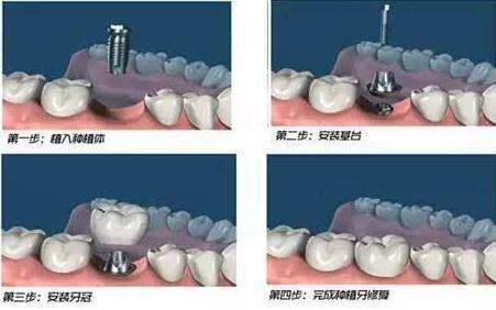 上海拔智齿哪个医院好？2023年上海智齿拔除医院排名及费用