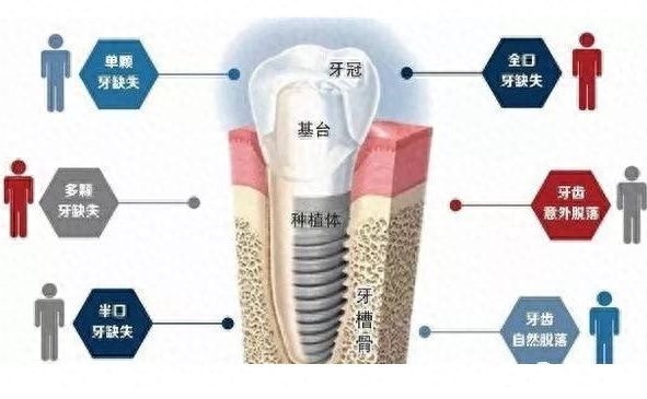 重庆上颌多生牙拔除医院推荐-附口碑医院名单