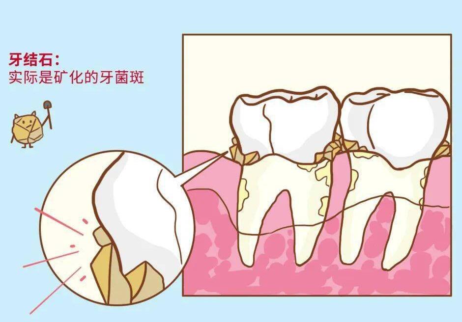 2023年上海新菲口腔门诊部牙种植价格及2023年术后二月收费明细查询