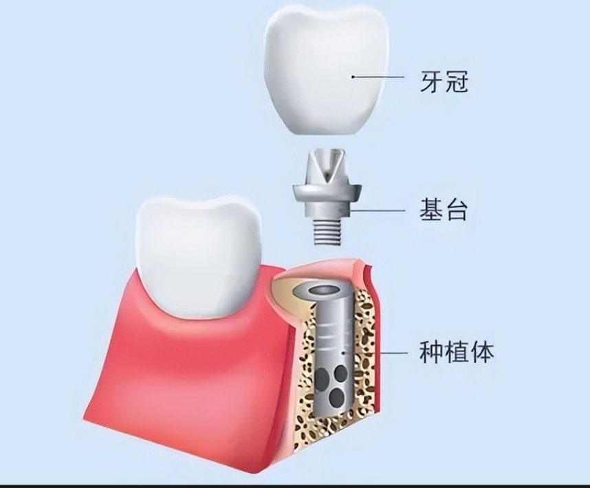 乌鲁木齐贴面美白哪家口腔医院好？2024口碑推荐！