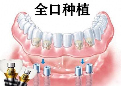 云南矫正深覆合靠谱的牙科医院推荐