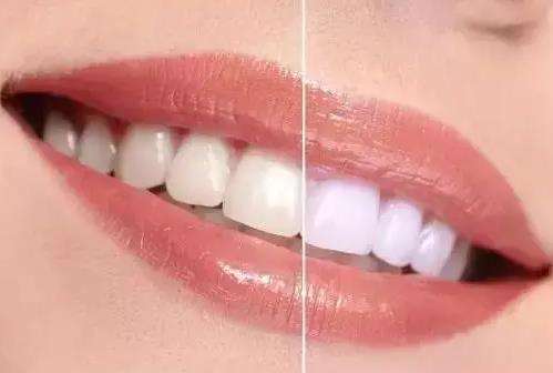 牙齿美白哪种方式更快速？对比贴面和冷光，完全解析牙齿美白方法！