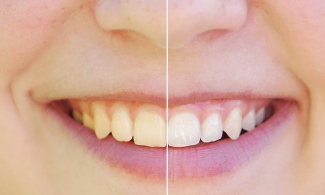 牙齿很黄是什么原因造成的?