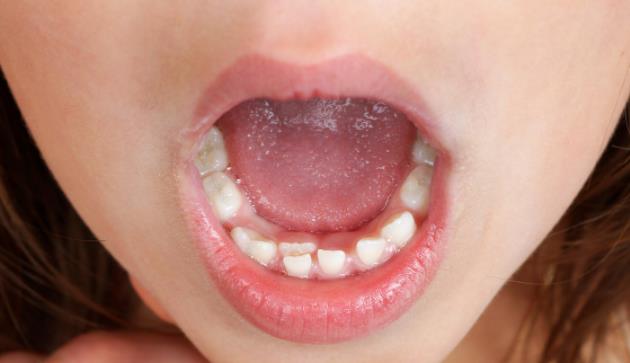 牙齿经常出血是什么原因引起的?牙齿经常出血是什么情况?