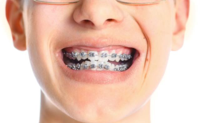 牙齿矫正对牙齿有什么不好的影响吗?牙齿矫正的危害大吗?