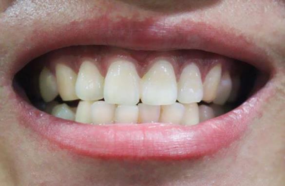 牙齿发黑是什么原因造成的?