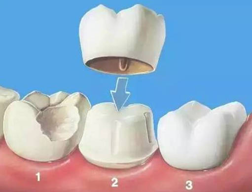 补牙治疗