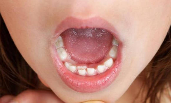 小孩子牙齿松动如何治疗