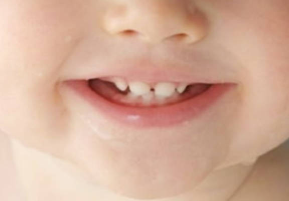 儿童牙齿松动怎么治疗