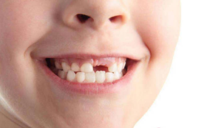 小孩子牙齿松动牙龈肿怎么办