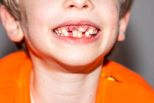 5岁孩子牙齿松动是怎么回事