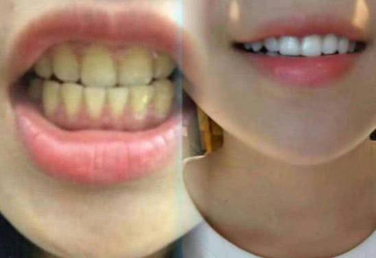 儿童牙齿发黄是什么原因引起的？儿童牙齿发黄有效变白方法有哪些？