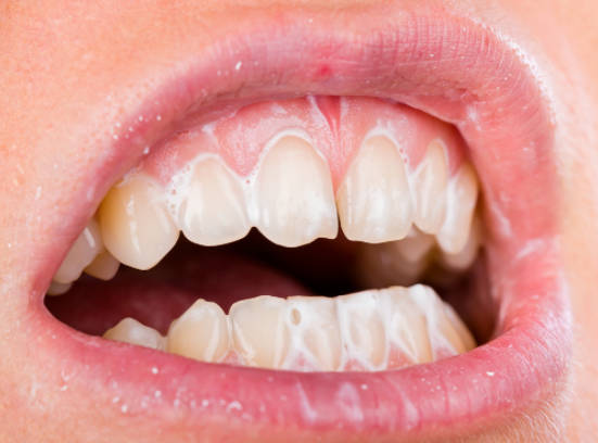 牙齿黄斑是不是牙结石