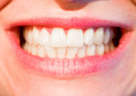 牙齿黄一般是什么原因导致的？牙齿黄该怎么办才能让牙齿变白？