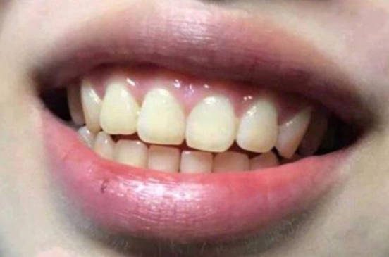 牙齿黄的原因