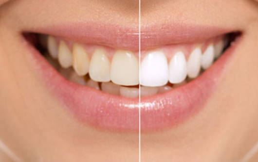 牙齿黄刷不白的原因有哪些？牙齿黄刷不白有什么好的办法？