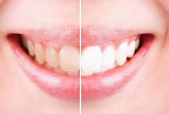 牙齿发黄刷不白大致原因有哪些？牙齿发黄适合用什么牙膏？