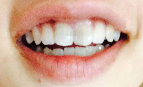 牙齿发黑是什么原因引起的？牙齿发黑如何有效的治疗？