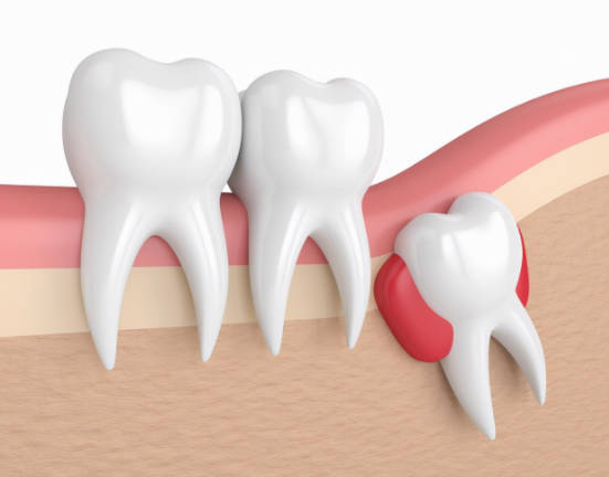 拔牙后如何预防牙龈发炎