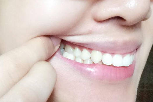 经常有牙龈炎是什么原因