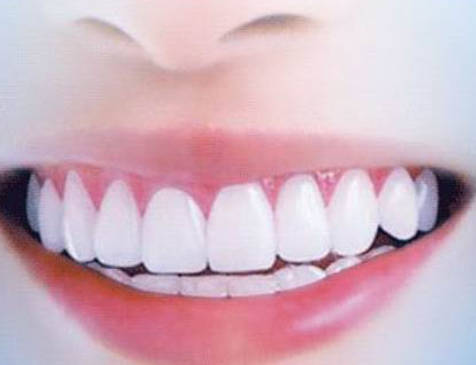 牙齿龋坏到什么程度需要做根管治疗