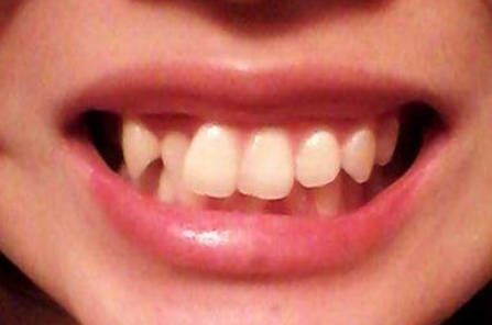 牙齿不齐的主要原因是什么