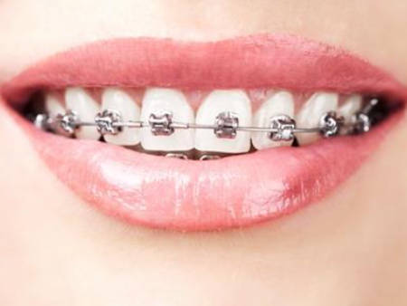 牙齿不齐会影响脸型五官吗？