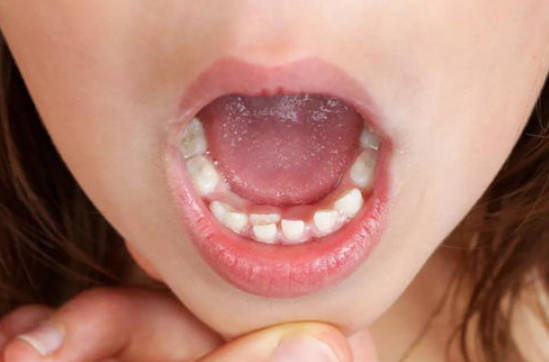 引起牙齿不齐的原因有哪些？