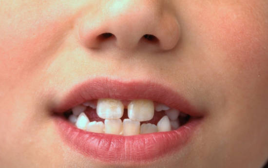 造成牙齿不齐的因素有哪些？