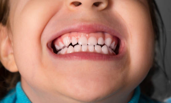孩子牙齿不齐有哪些原因