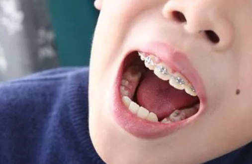小孩子牙齿不齐的原因是什么