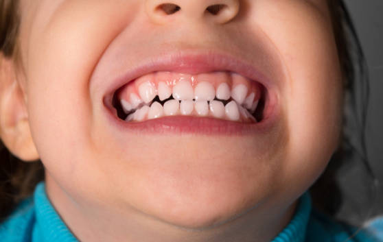 小孩牙齿长不整齐是什么原因