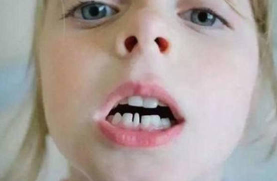 小孩牙齿不齐几岁矫正最好
