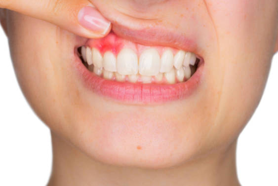 引起牙龈出血的原因有哪些