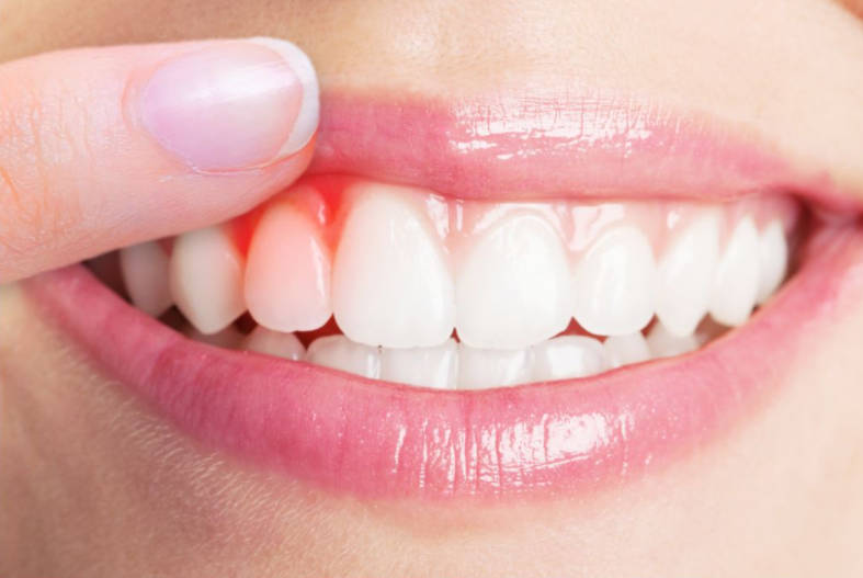 牙龈出血一般是有哪些原因引起的