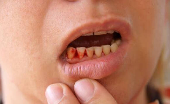 牙龈出血是哪些问题造成的