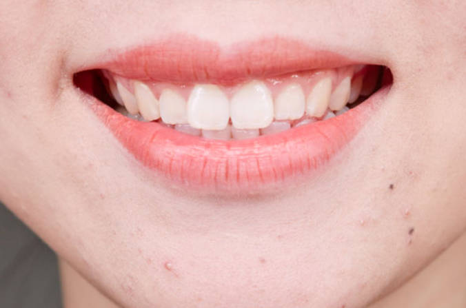 刷牙牙龈出血是什么病征兆？