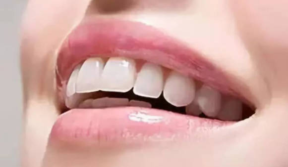 牙齿美白使用哪种方法好?