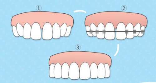 重庆口腔专家推荐有效的牙齿矫正方案