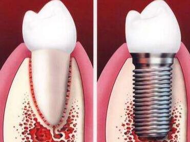广州口腔种植牙：费用及专家医生介绍