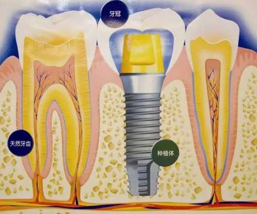 海口三亚种植牙一览：微笑口腔收费全解析