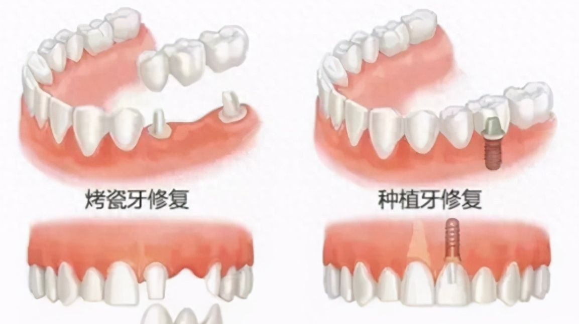 淮安明溪口腔三院正畸、种牙价格实惠，网评可信赖