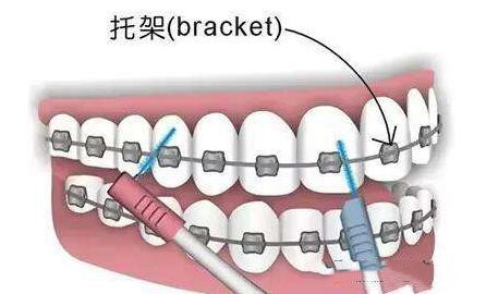 石家庄哪家医院牙齿矫正效果好 看看医生价格,推荐一下