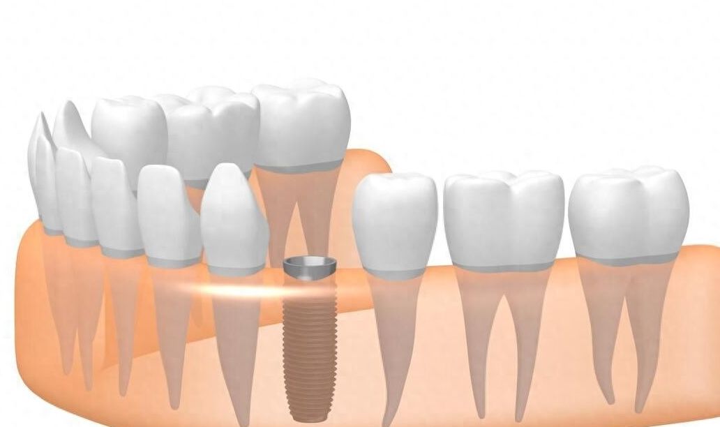 2024年潍坊种植牙价格一览：单颗、半全口费用对比！