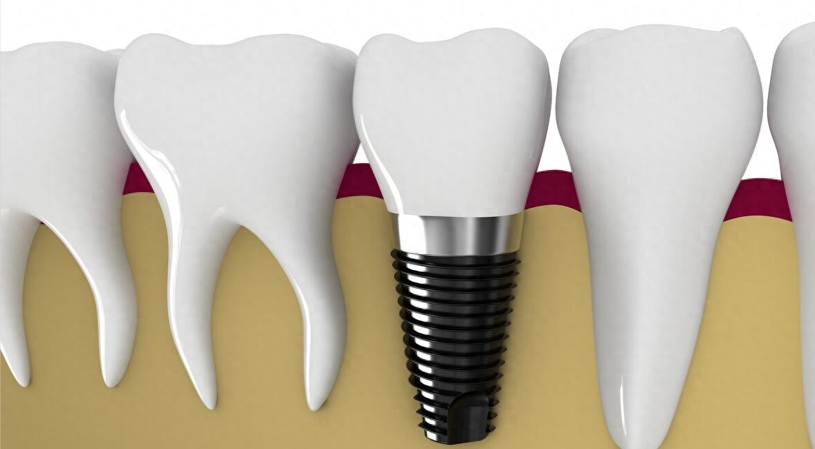 2024全国鼎植口腔种植牙收费大公开：单颗、半口、全口种植牙价格一览