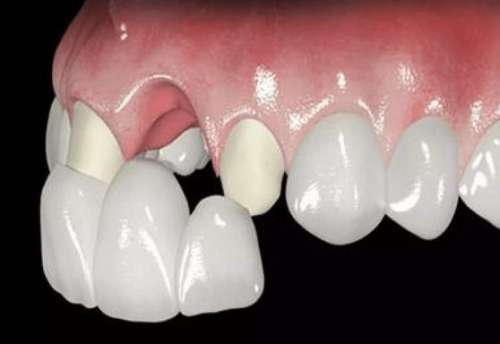 宁德牙科医院推荐及价格指南：2024整牙种植牙