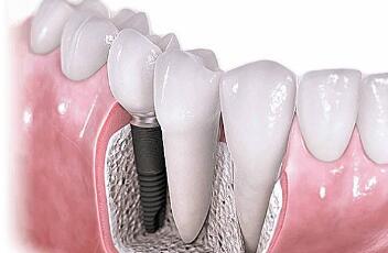 杭州牙科医院全面解析种植牙前的十大关键信息